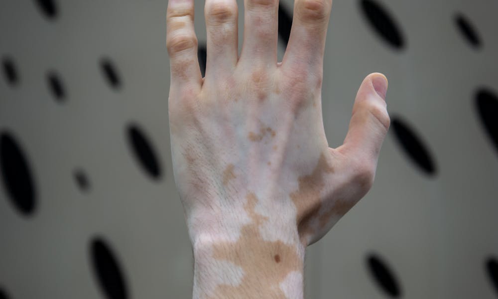 Close-up of Man Hand with Vitiligo .pexels